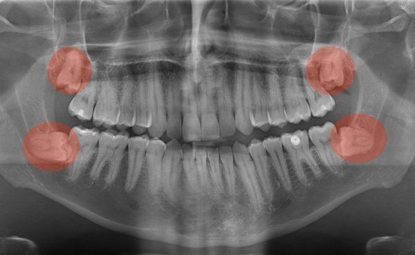 Röntgenbild von den Zähnen mit Weisheitszähnen