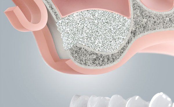 Sinuslift im Oberkiefer zum Knochenaufbau bei Zahnimplantaten