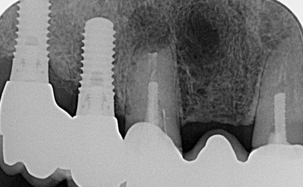 Röntgenbild von einem Zahn nach Wurzelspitzenresektion (WSR)