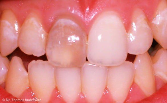 Aufhellung einzelner Zähne, v.a. nach Wurzelbehandlung