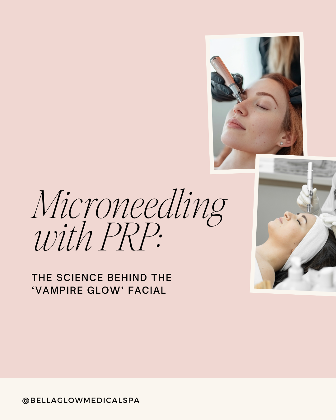 Microneedling with PRP promotion. Woman receiving facial treatment at spa.