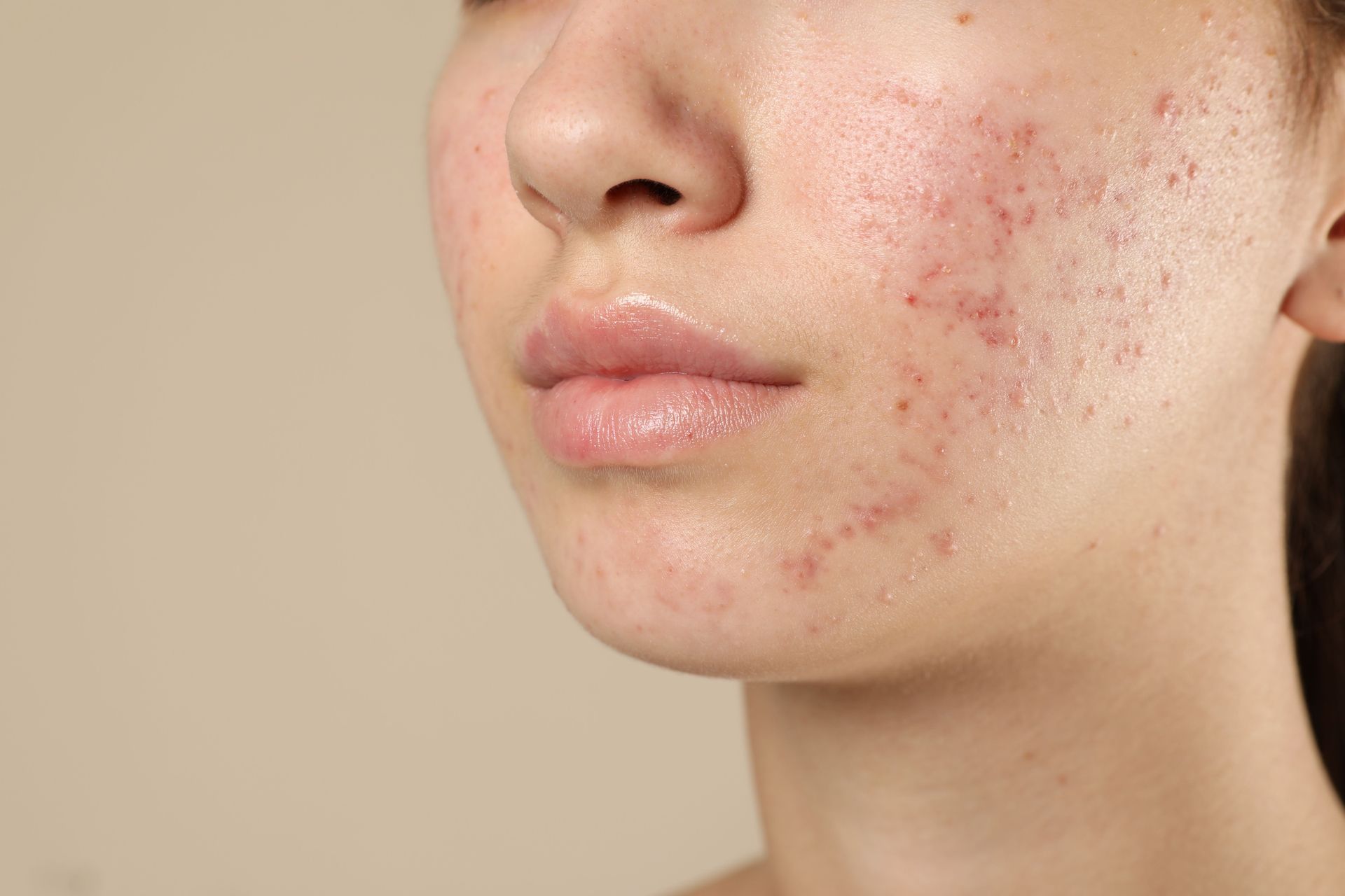 A close up of a woman 's face with acne on it.