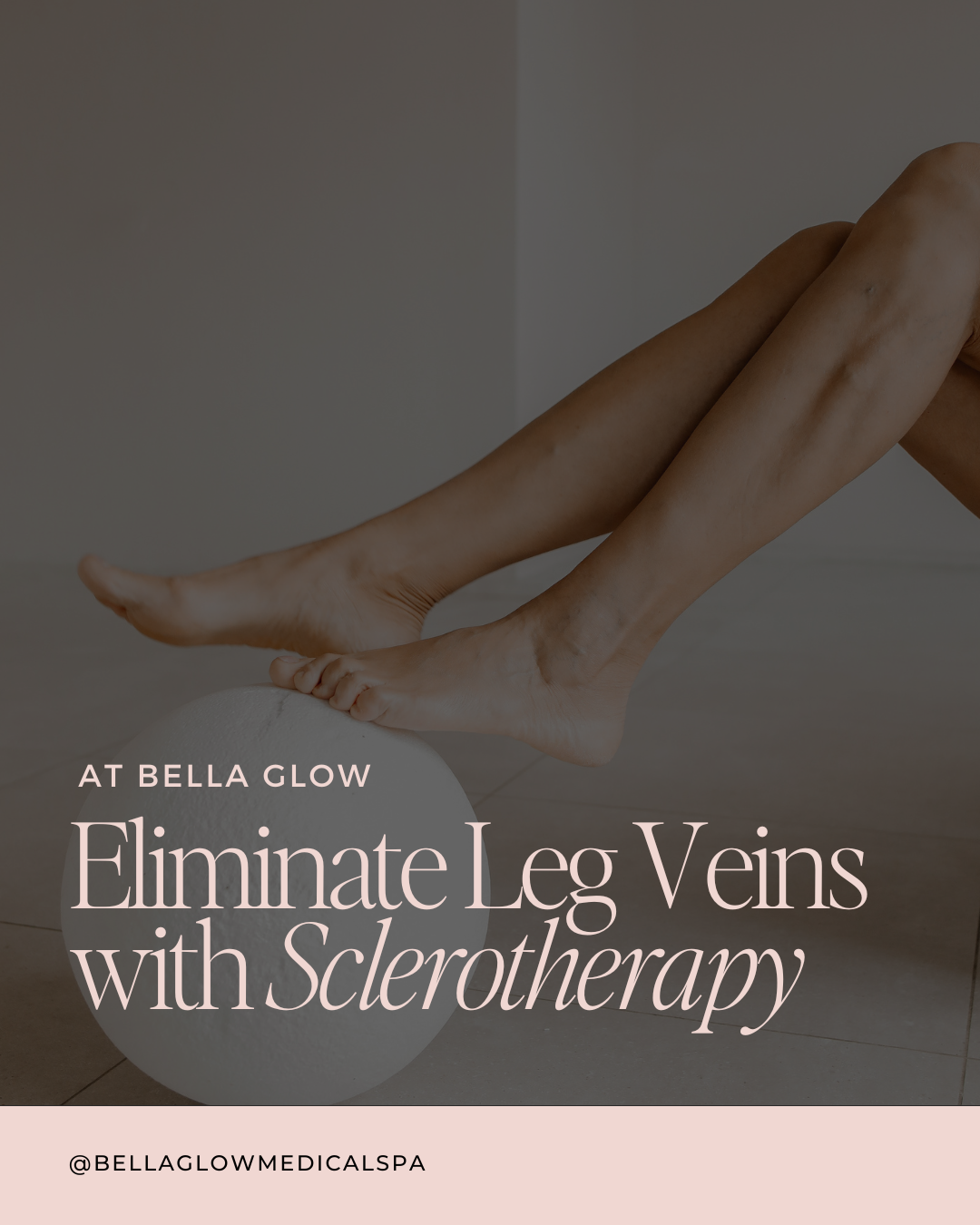 Bare legs resting on a white ball, promoting sclerotherapy at Bella Glow.