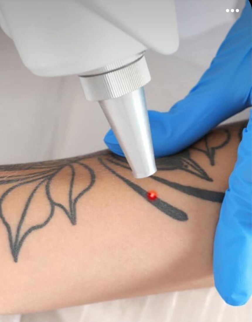 A Person is Getting a Tattoo Removed From Their Arm — Renew Laser Clinic in Taree, NSW