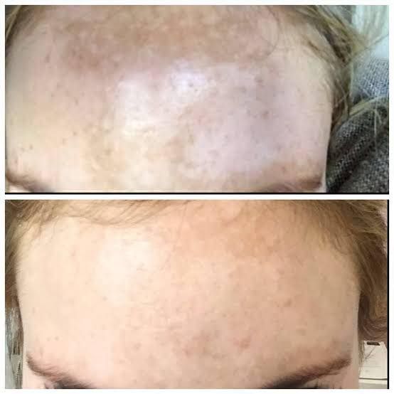 A Before and After Photo of a Woman's Forehead With Freckles — Renew Laser Clinic in Taree, NSW