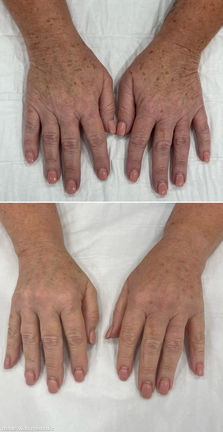 A Before and After Picture of a Person's Hands on a Bed — Renew Laser Clinic in Taree, NSW