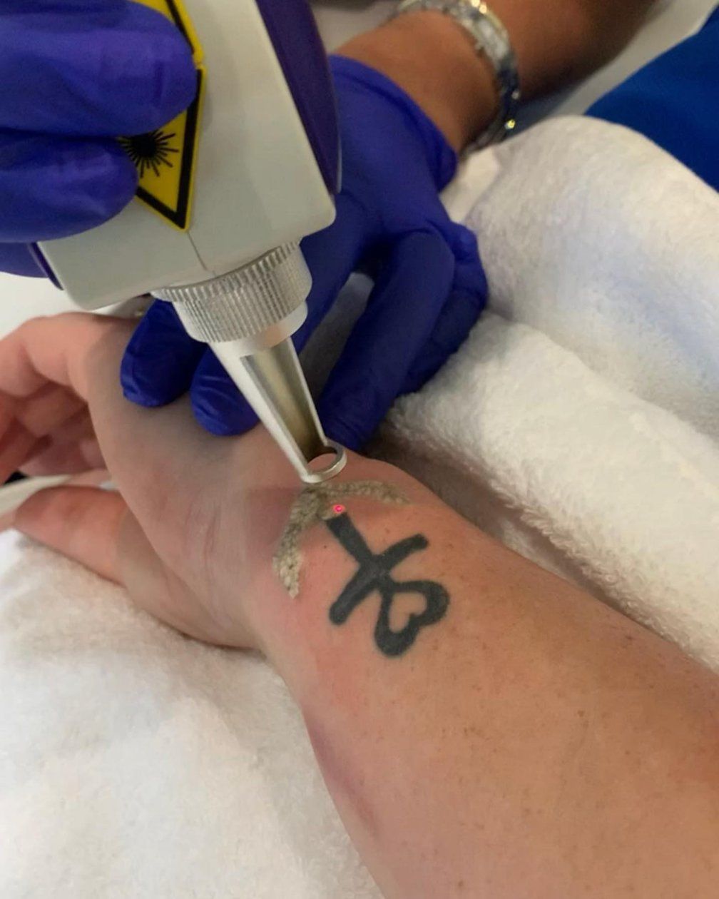 A Person is Getting a Tattoo Removed From Their Arm — Renew Laser Clinic in Taree, NSW