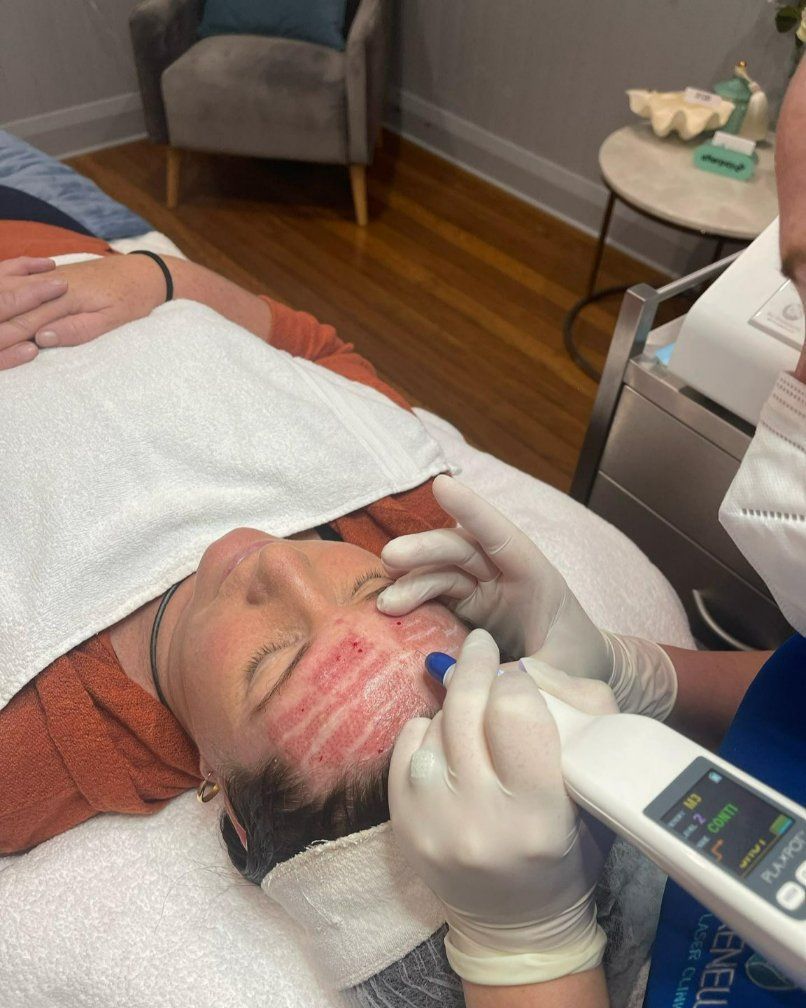 A Woman is Laying on a Bed Getting a Facial Treatment — Renew Laser Clinic in Taree, NSW