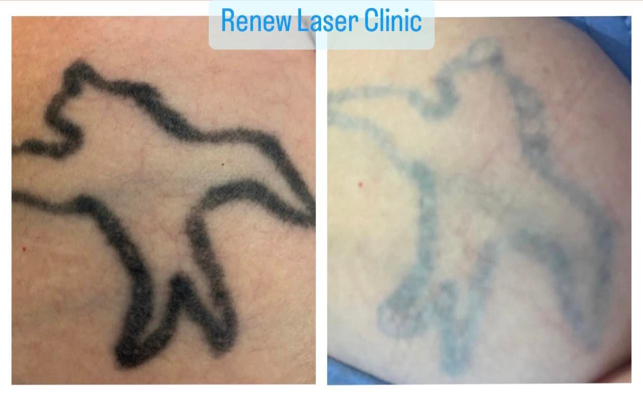 A Before and After Picture of a Tattoo on a Person's Arm — Renew Laser Clinic in Taree, NSW