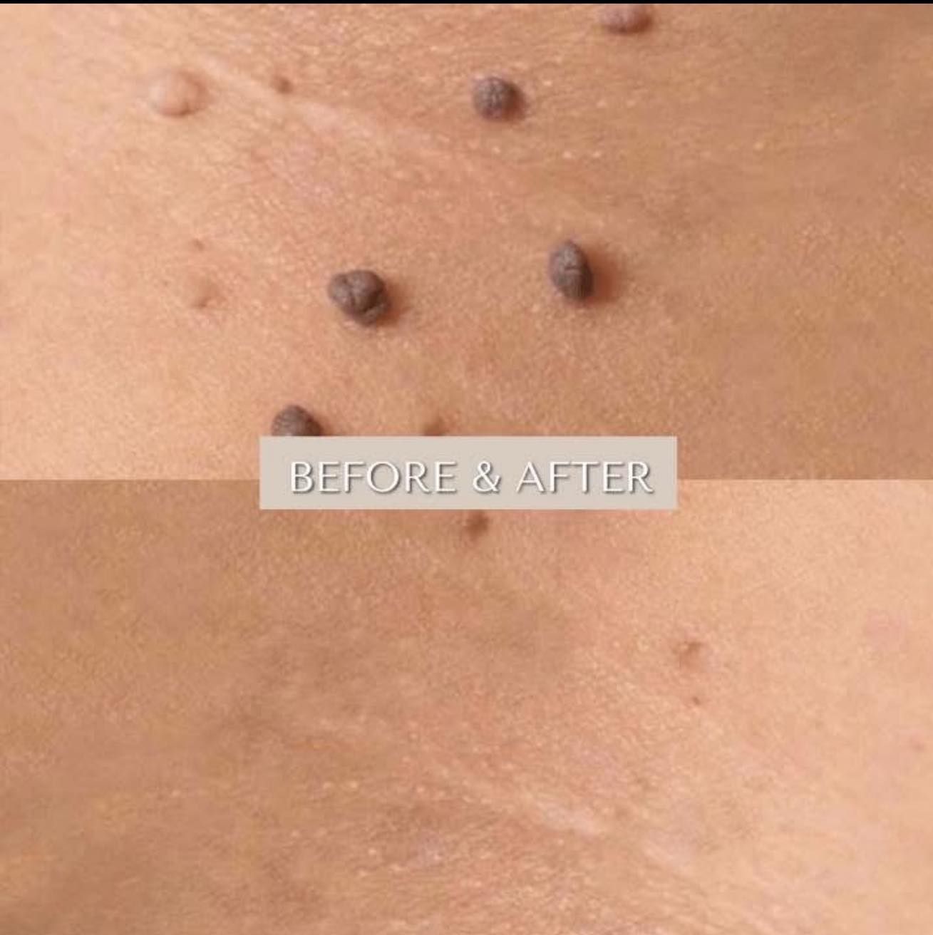 A Before and After Picture of a Person's Skin With Moles — Renew Laser Clinic in Taree, NSW