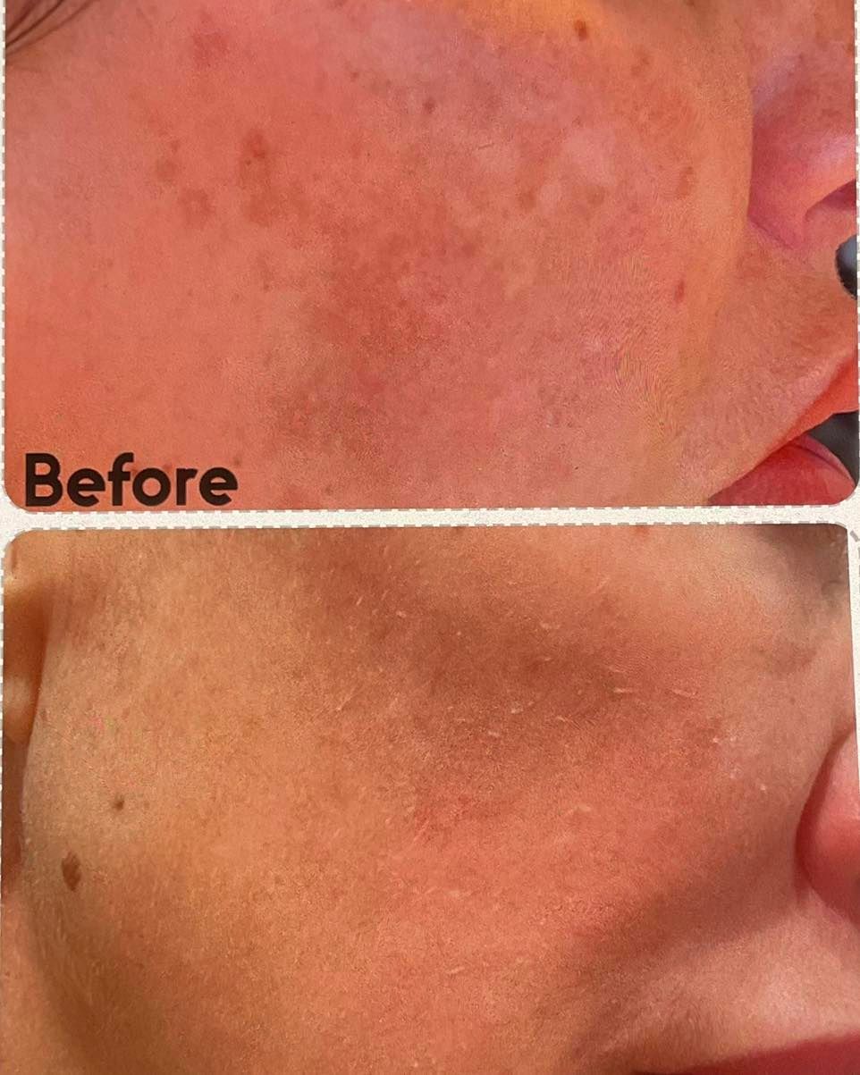 A Before and After Photo of a Woman's Face With Freckles — Renew Laser Clinic in Taree, NSW