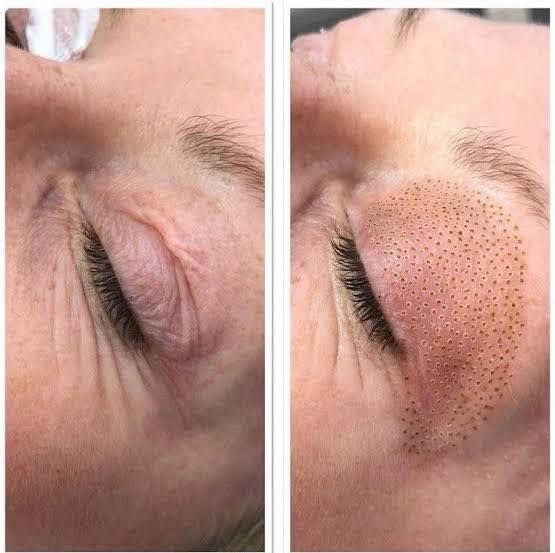 A Before and After Photo of a Woman's Eye — Renew Laser Clinic in Taree, NSW