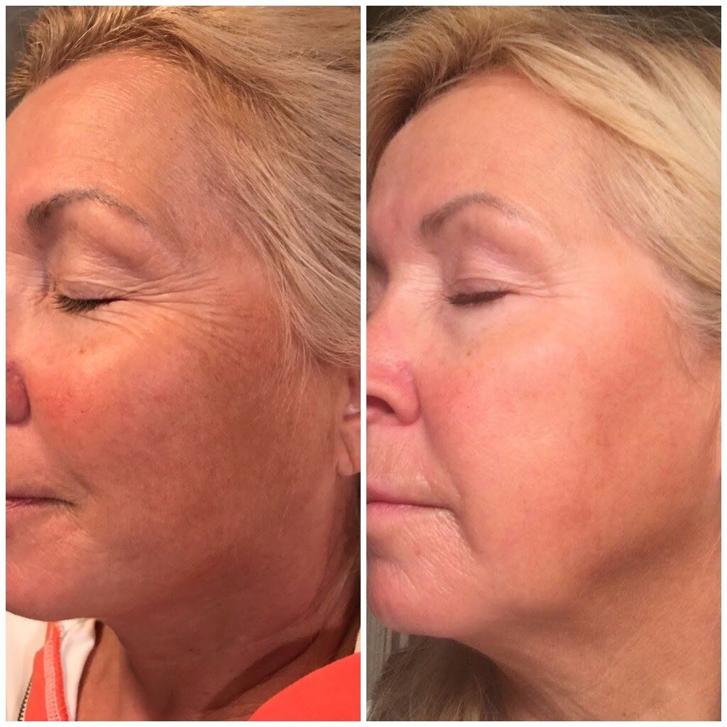 A Before and After Photo of a Woman's Face — Renew Laser Clinic in Taree, NSW