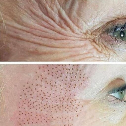 A Before and After Picture of a Woman's Face With Wrinkles — Renew Laser Clinic in Taree, NSW