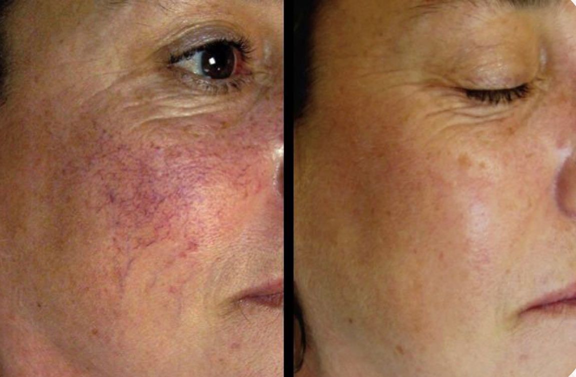 A Before and After Photo of a Woman's Face With Red Veins — Renew Laser Clinic in Taree, NSW