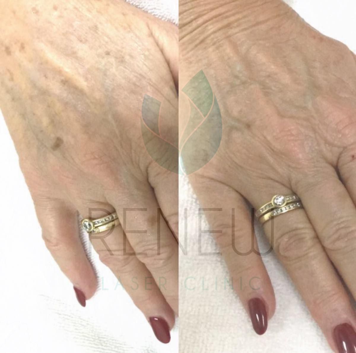 A Before and After Photo of a Woman's Hands — Renew Laser Clinic in Taree, NSW