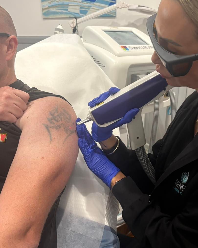 Laser Tattoo Removal Procedure in Progress — Renew Laser Clinic in Taree, NSW