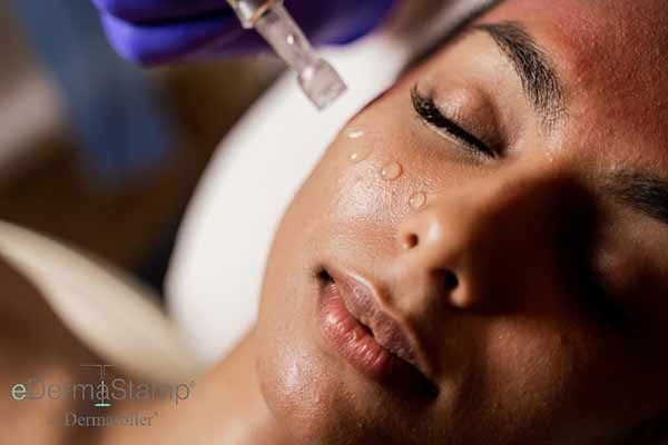 A Woman is Getting a Treatment on Her Face — Renew Laser Clinic in Taree, NSW