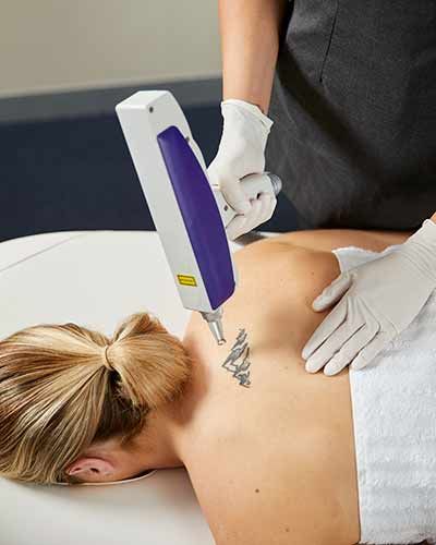 A Woman is Getting a Tattoo Removed From Her Back — Renew Laser Clinic in Taree, NSW