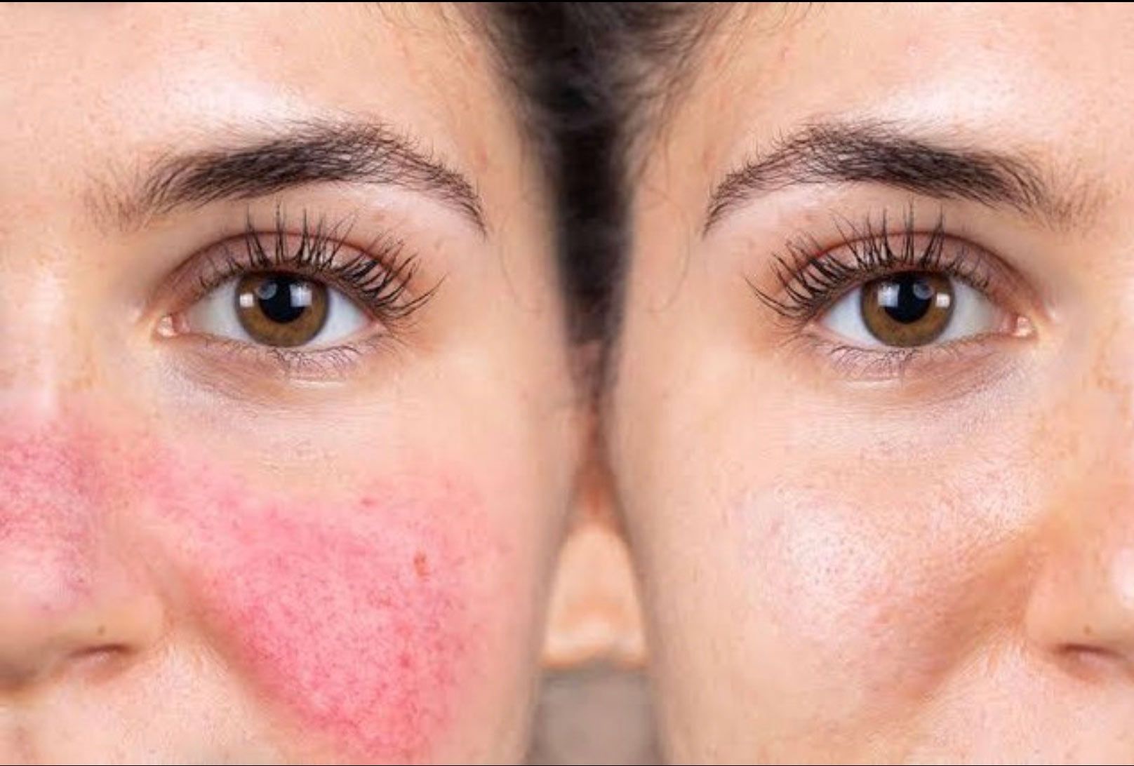 A before and after picture of a woman 's face with rosacea — Renew Laser Clinic in Taree, NSW