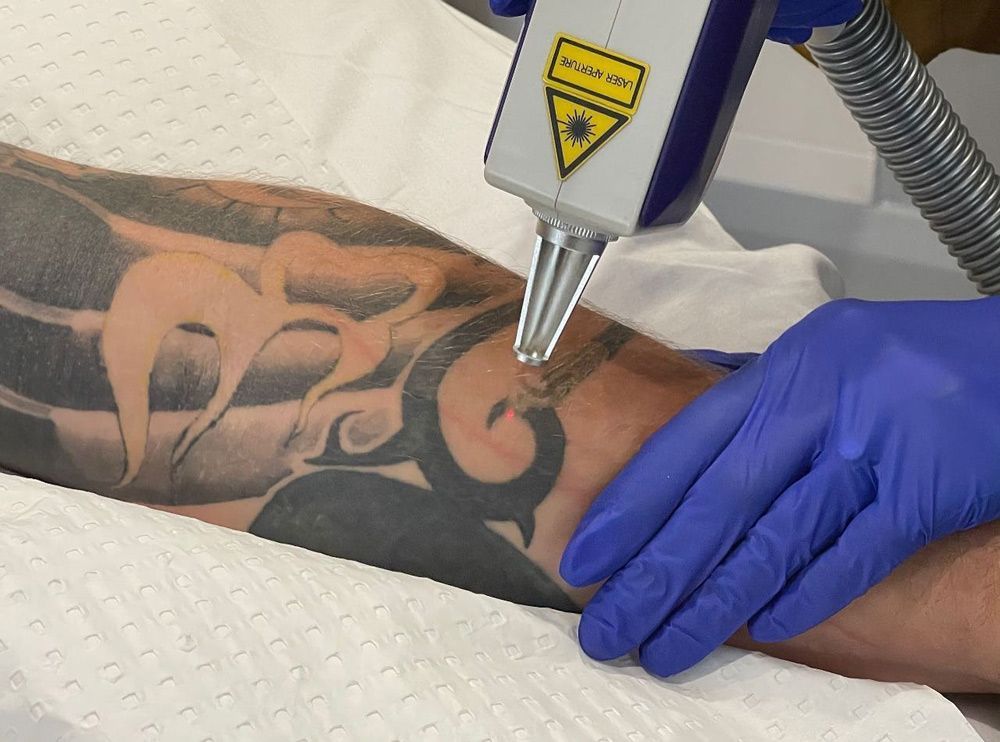 closer look of a safe Tattoo removal treatments