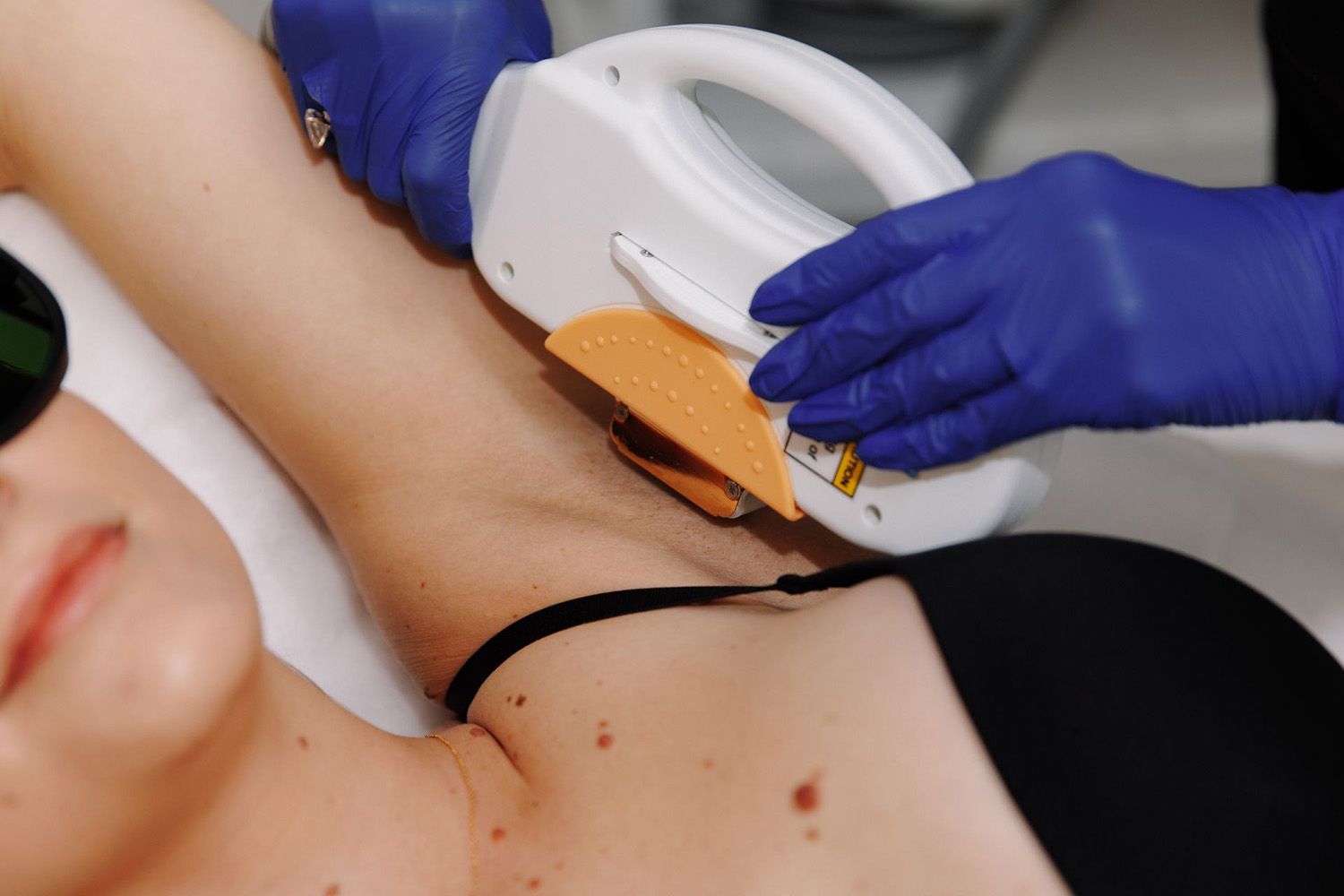 Laser Hair Removal On A Woman's Underarm
