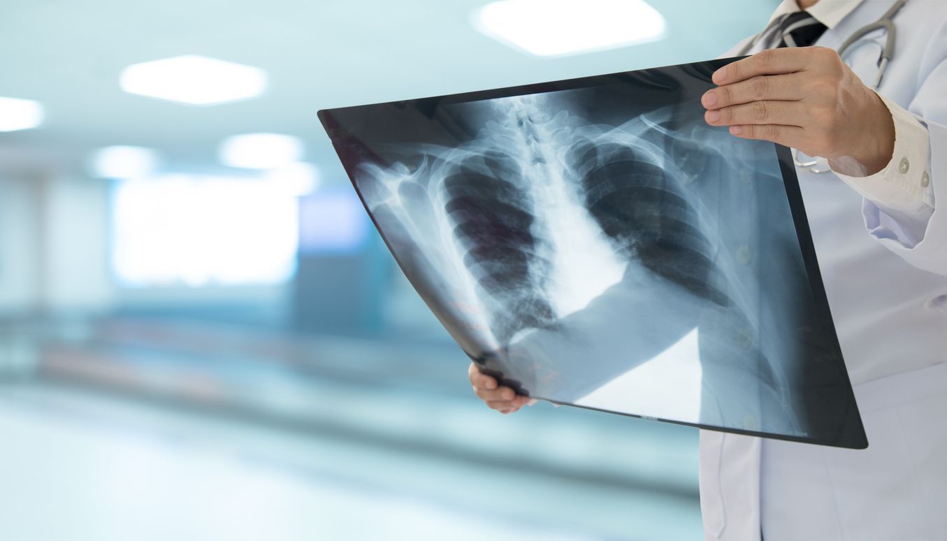 Doctor in white coat holding an X-ray of a chest in a hospital setting.