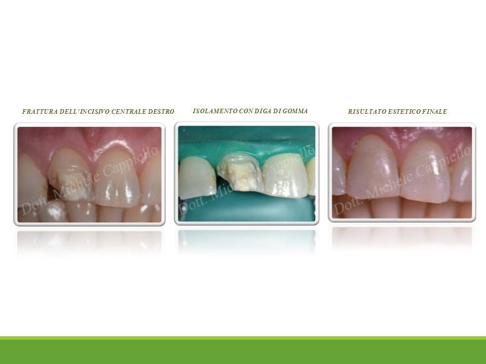 devitalizzazione del dente