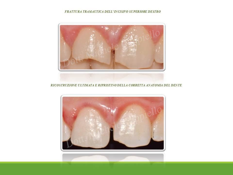 trattamenti di endodonzia