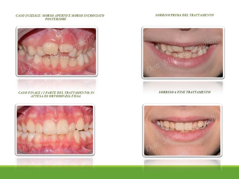 apparecchio dentale fisso