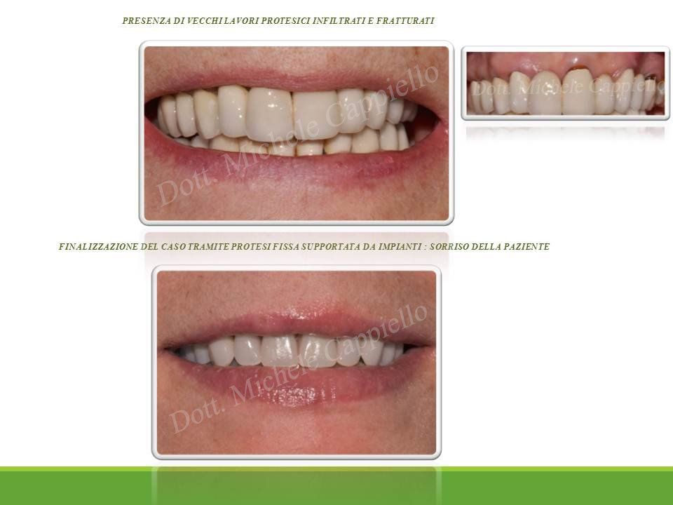sbiancamento denti