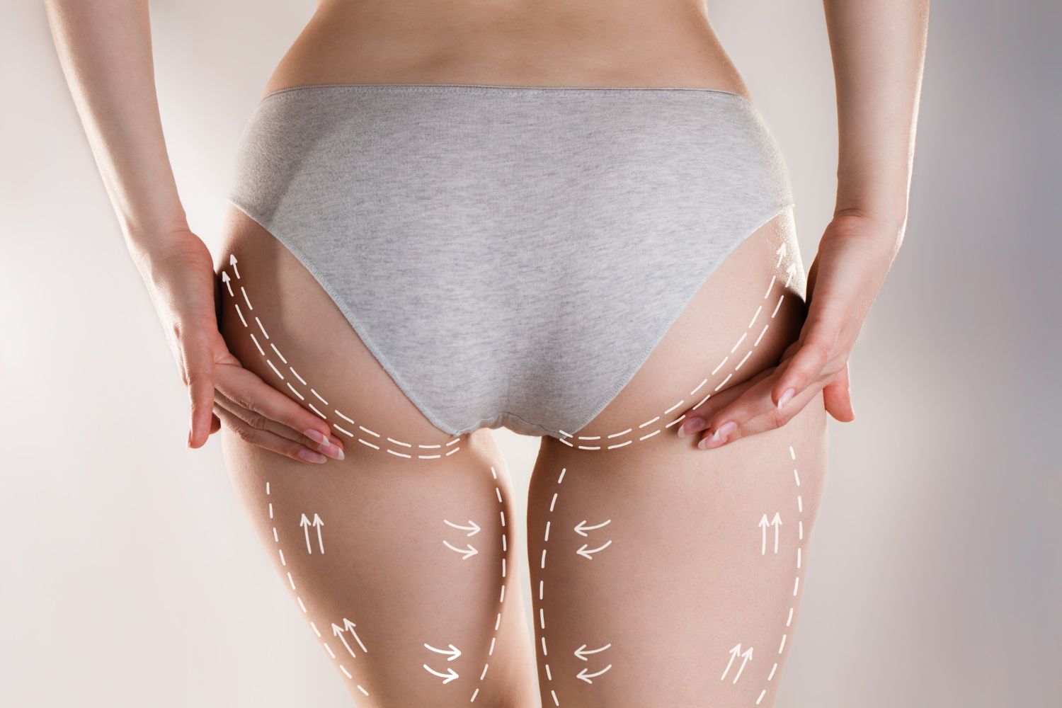 Person in gray underwear holding thighs, with dotted markings on skin against a light background