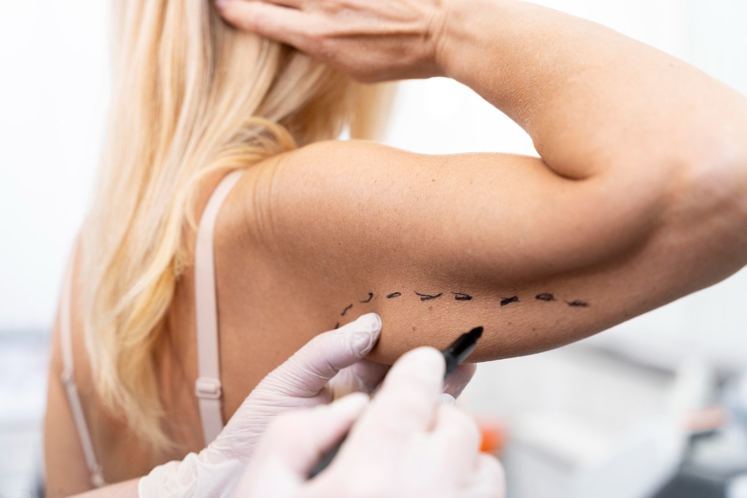 Doctor marking a blonde woman’s upper arm with a pen during a cosmetic consultation