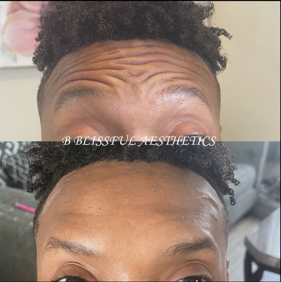 A before and after photo of a man 's forehead