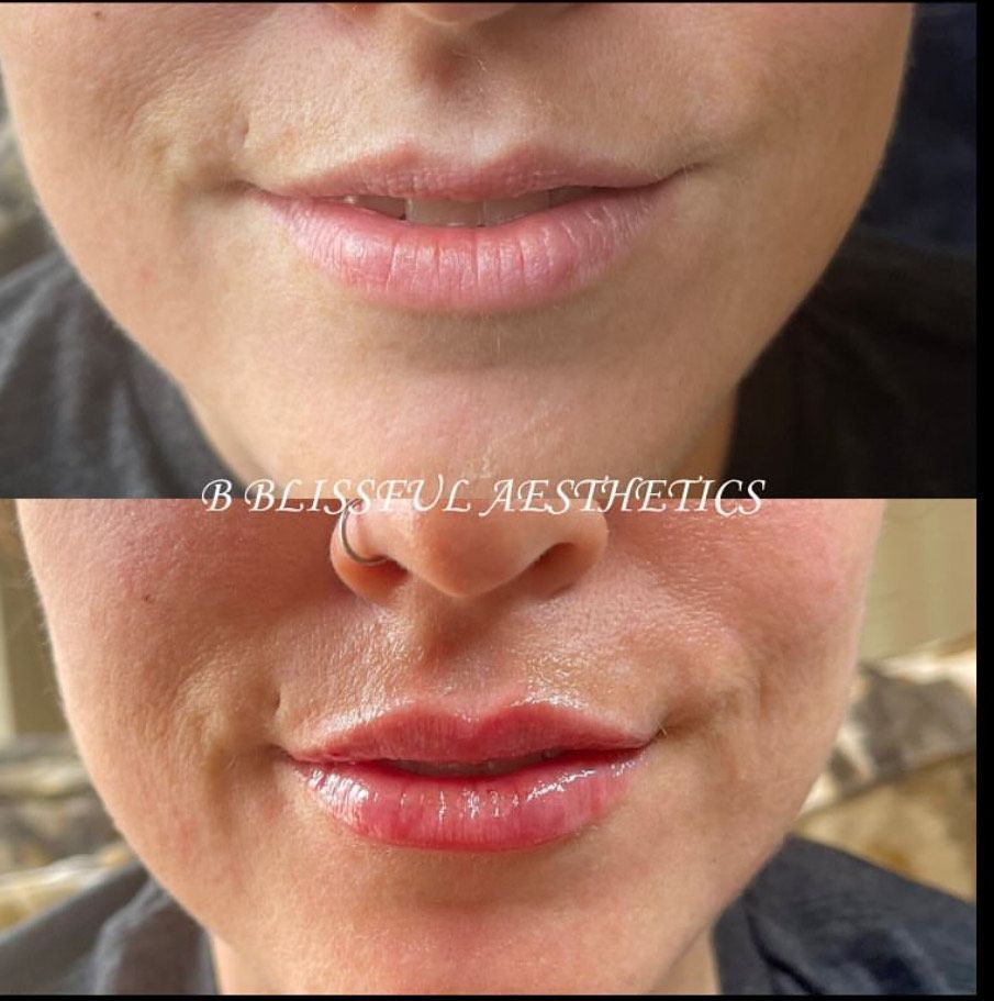 A before and after photo of a woman 's lips taken by blissful aesthetics