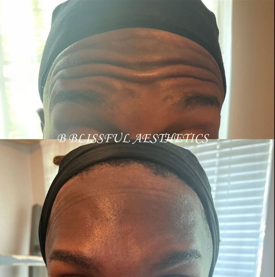 A before and after photo of a woman 's forehead