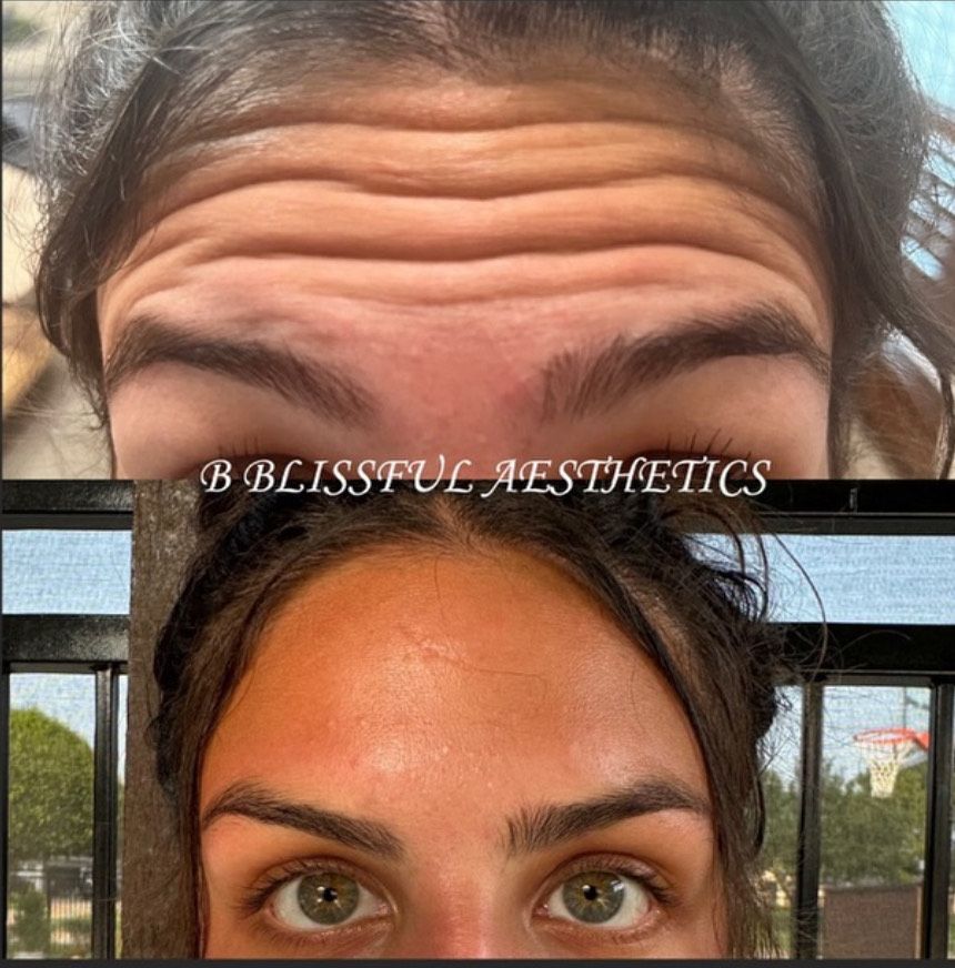 A woman 's forehead is shown before and after botox injections.