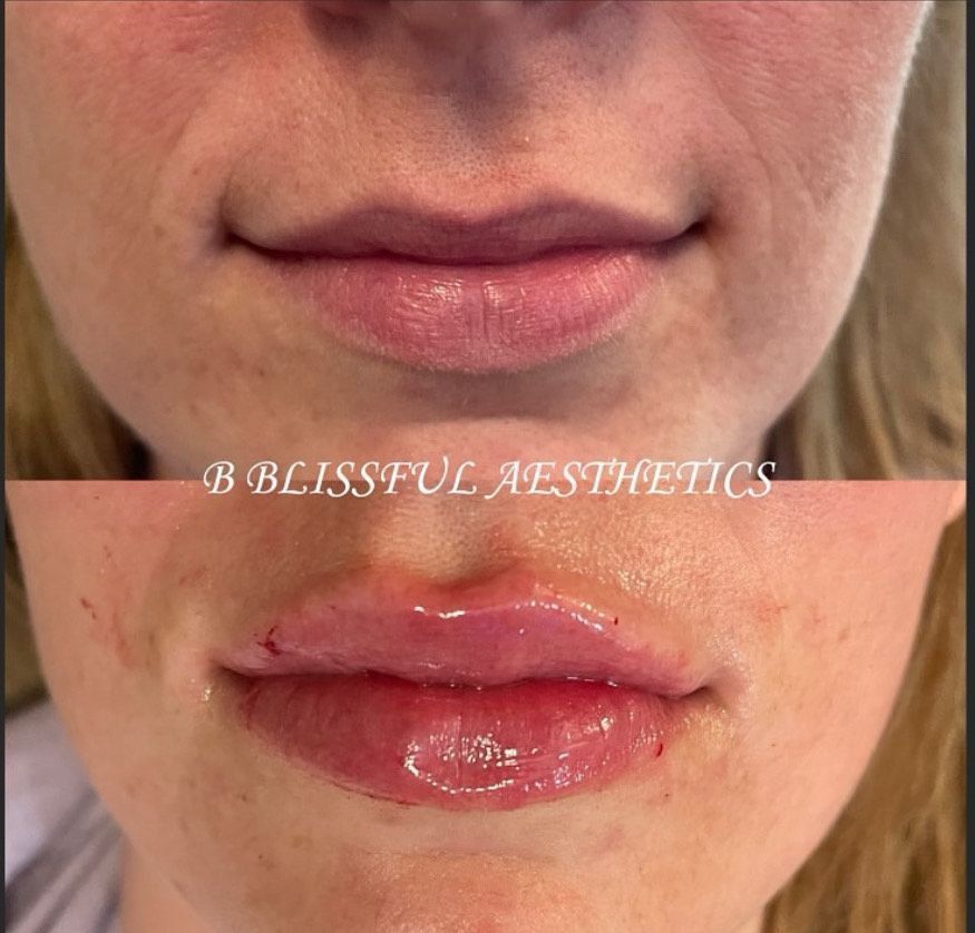 A before and after photo of a woman 's lips taken by blissful aesthetics