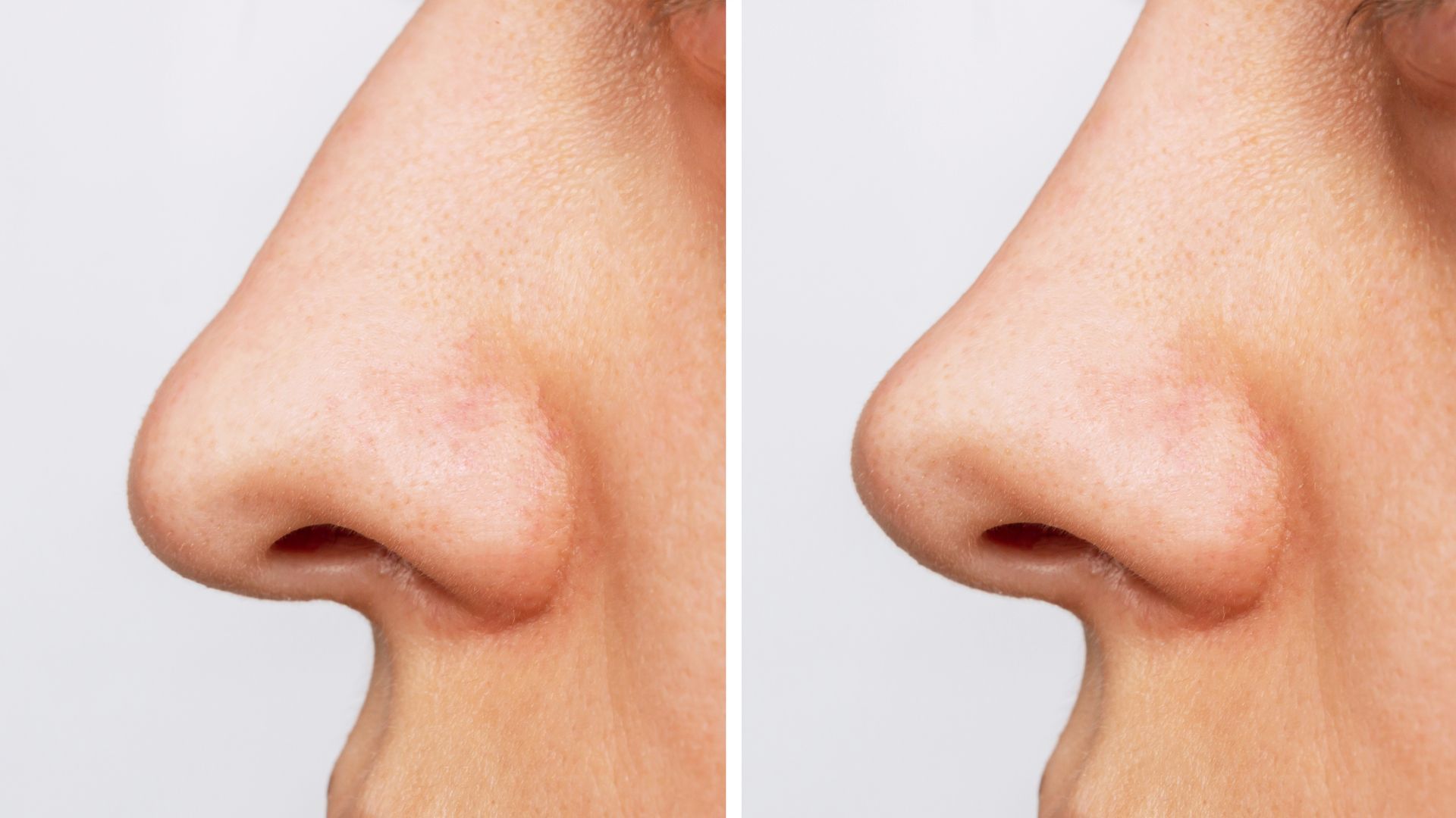Side-by-side comparison of a nose before and after rhinoplasty, showing a change in shape.