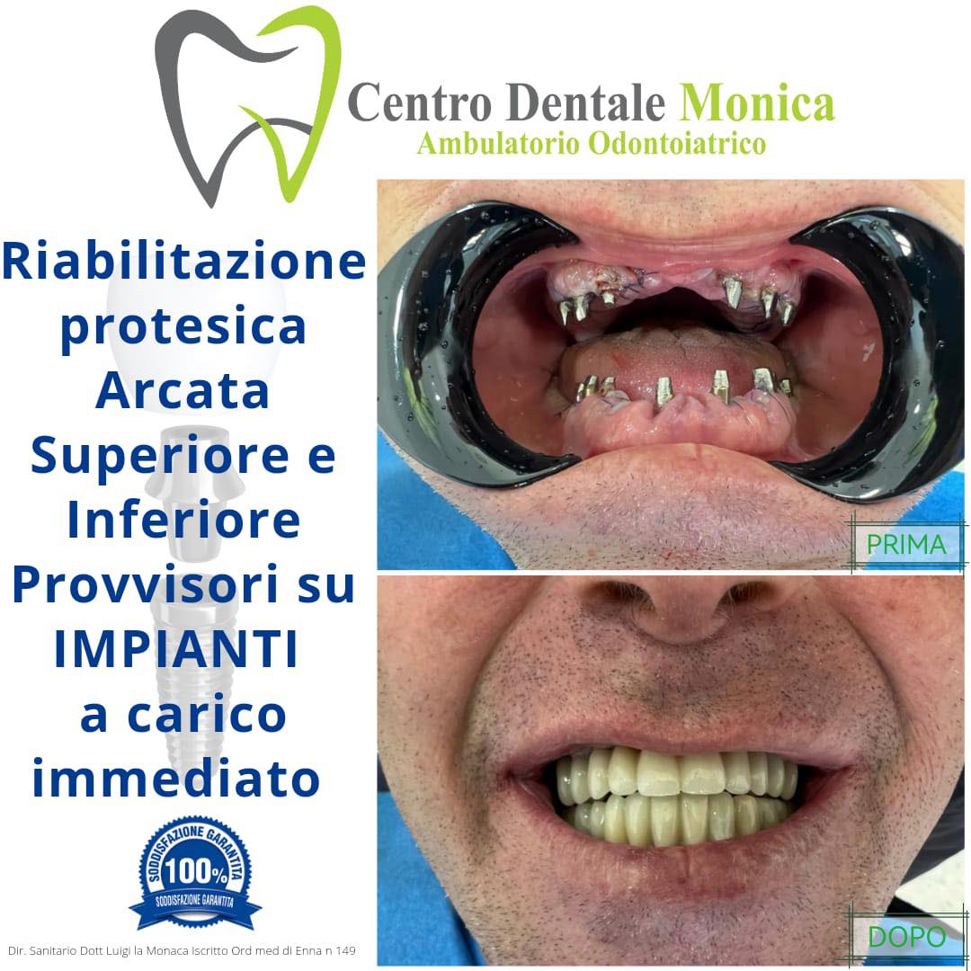 servizio di riabilitazione protesica arcata superiore e inferiore