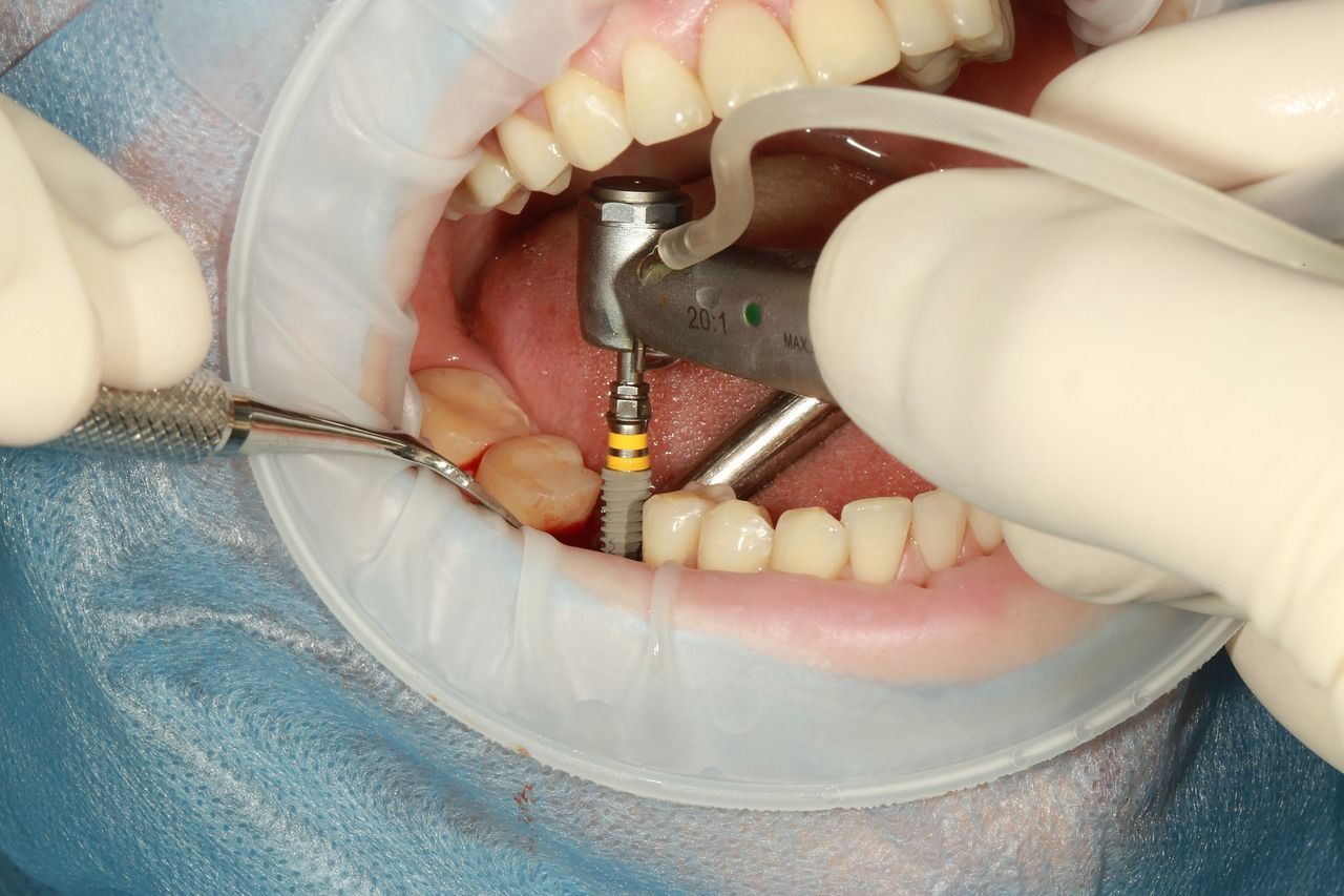 A dentist is working on a patient's dental implants.