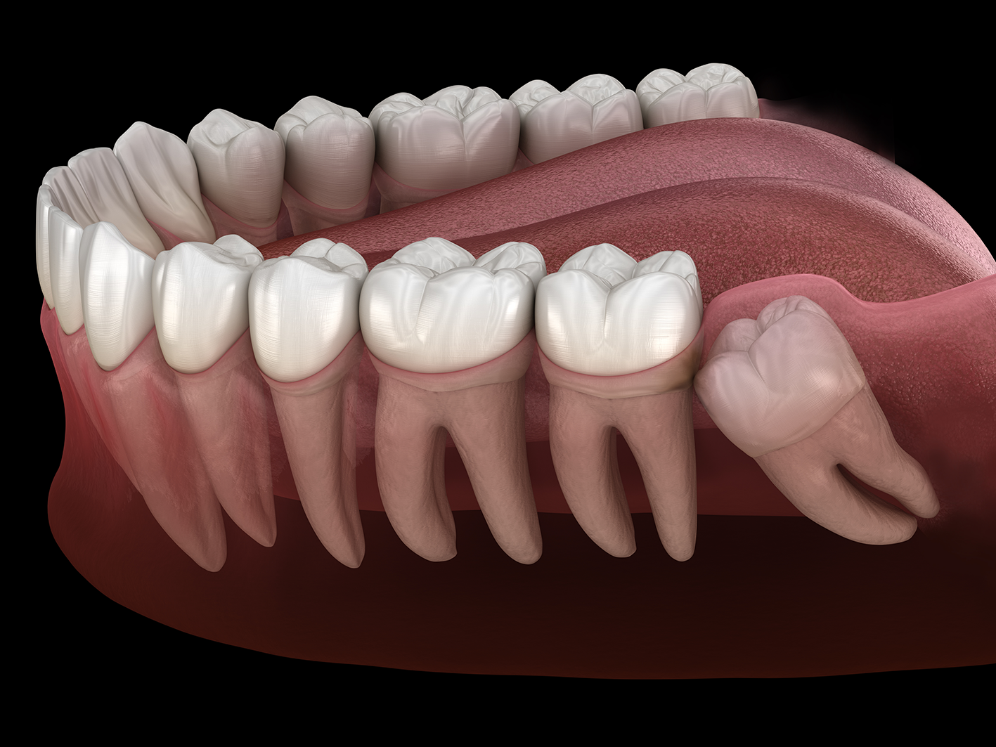 model of compacted wisdom teeth