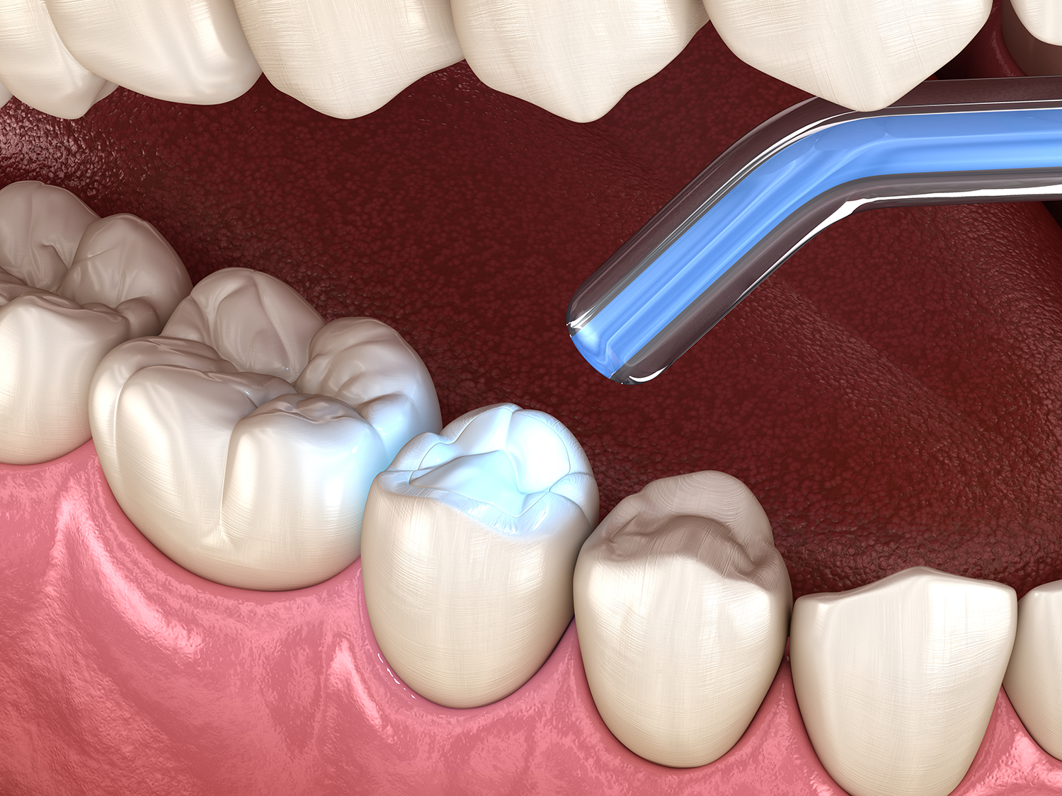 dental bonding of model teeth