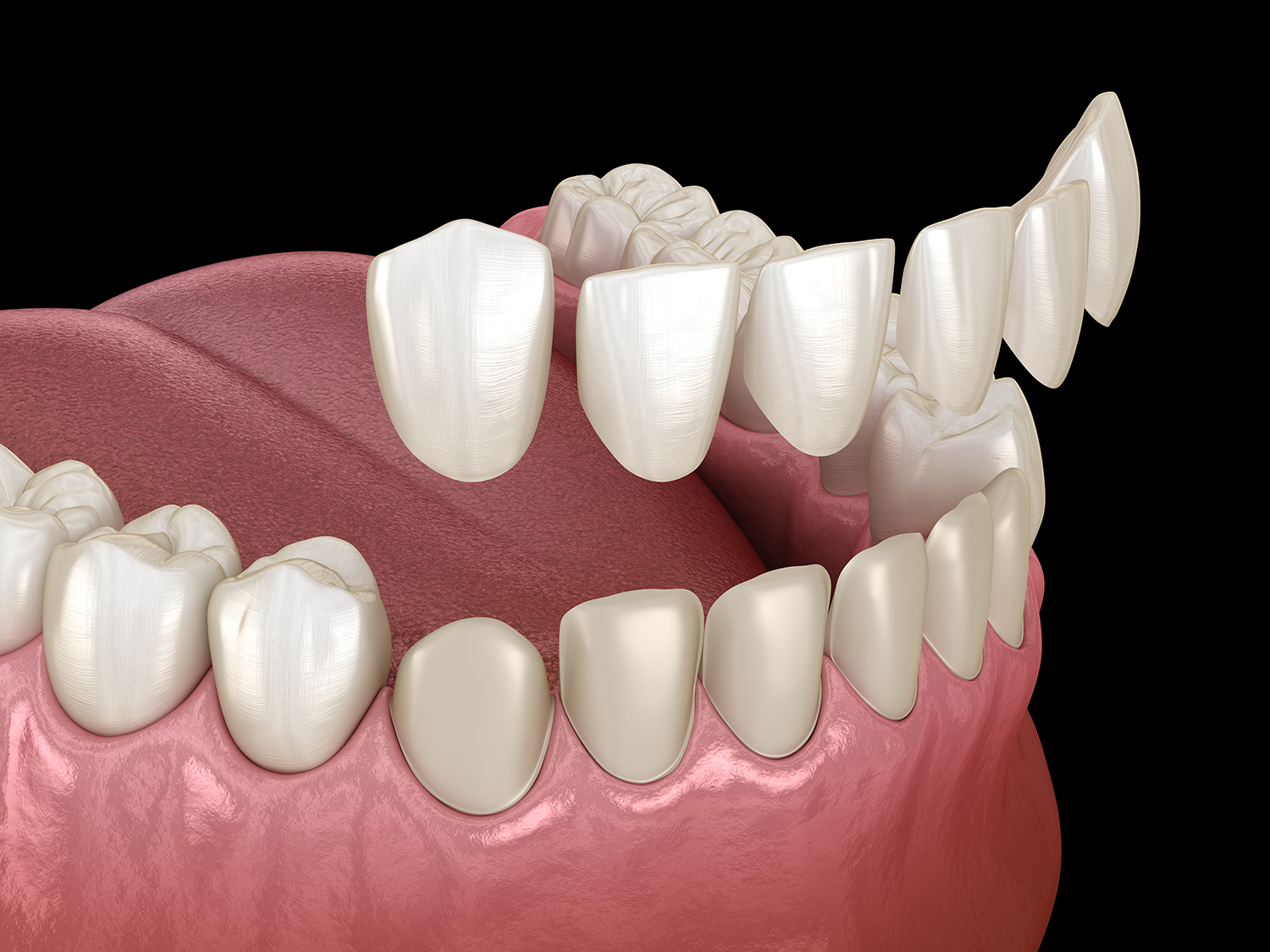 dental veneers model