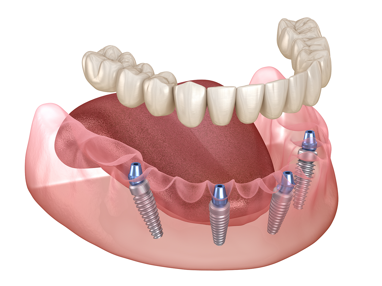 dental implants with dentures