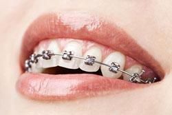 woman showing upper teeth braces  - Lincoln, NE - Blome Family Dentistry