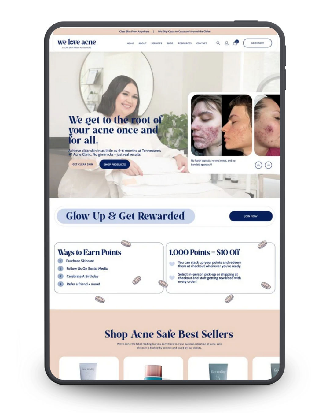 Website promoting acne treatment, with before/after photos and rewards program info.