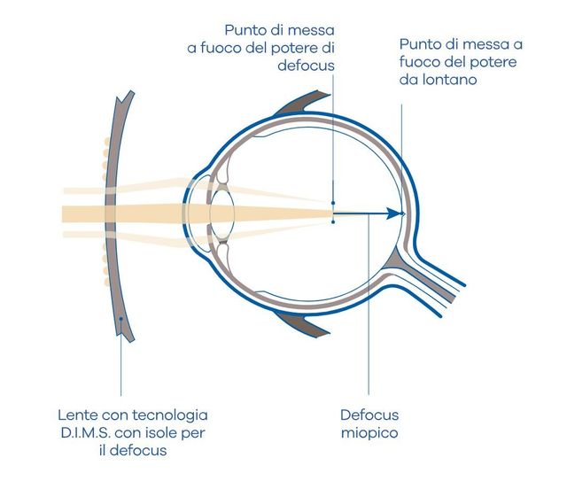 Lenti per la gestione della miopia dei bambini | Ottica Gentile