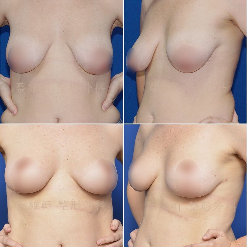 三幅乳房插圖，顯示乳頭相對於乳房輪廓的不同位置。