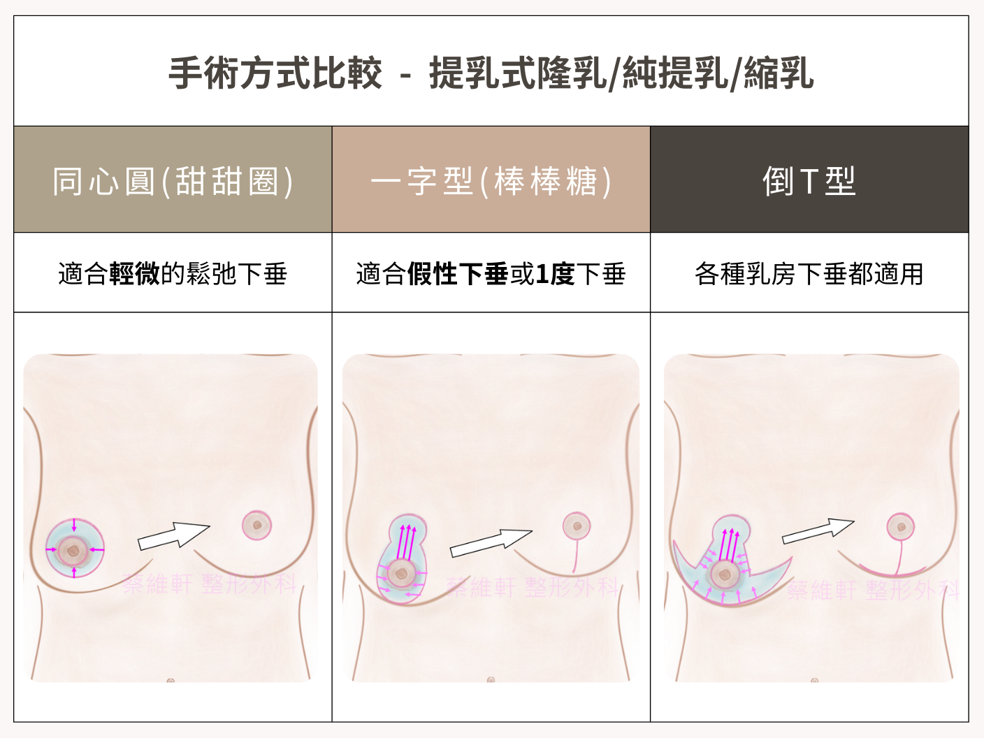 三幅乳房插圖，顯示乳頭相對於乳房輪廓的不同位置。